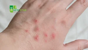 bug bites and how to identify them